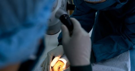 Cataract surgery
